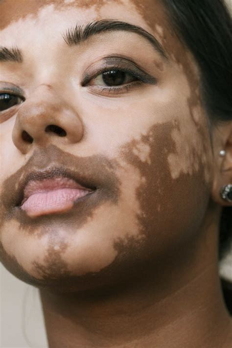 le vitiligo mis en lumière par une photographe elle même atteinte lors d un shooting d exception