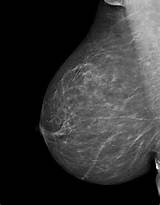Pictures of Is Mammogram Covered By Medicare