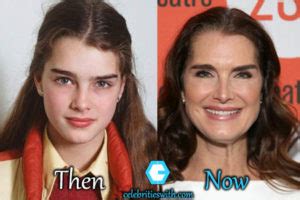Brooke Shields Plastic Surgery Botox Facelift Before After Pics
