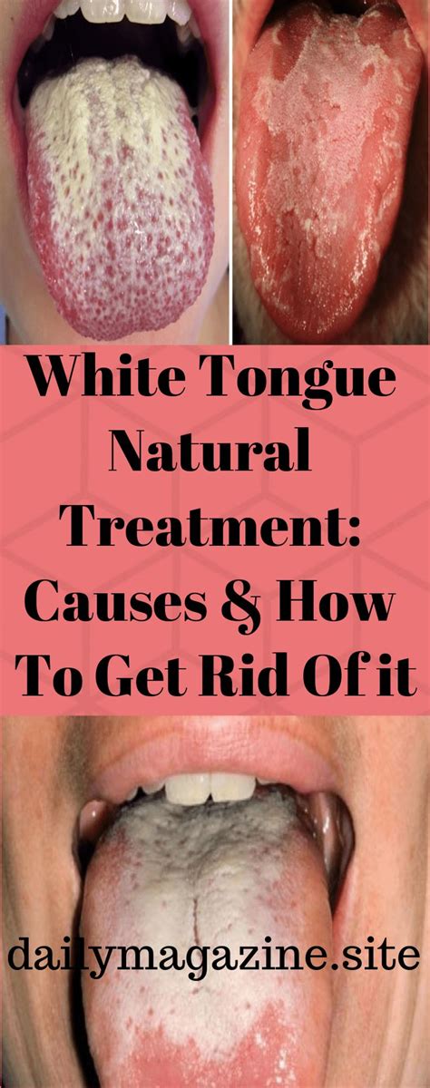 White Tongue Natural Treatment Causes And How To Get Rid Of It White