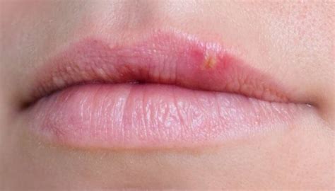 What Are These White Dots Known As Fordyce Spots On My Lips