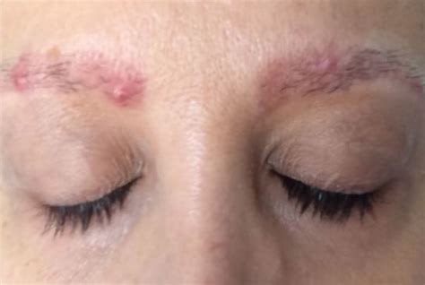 Pimple On Eyebrow Under Between Near Above Swollen Eyelid Get Rid