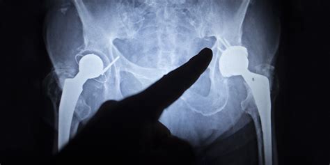 Best Surgical Approach For Hip Replacement Surgery Portsmouth Nh