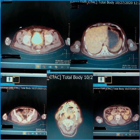 Pet Ct Scan Showing Hypermetabolic Sub Centimetric Cervical Lymph Nodes