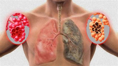 Emphysema Small Engineered Peptide Pr1p Reduce Apoptosis Protecting