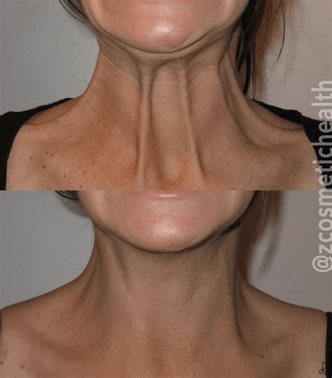 Try These Treatments For Neck Bands Z Cosmetic Health Blog