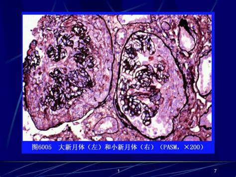 Ppt 过敏性紫癜 Hsp （ Anaphylactoid Purpura ） 夏晓玲 Powerpoint Presentation