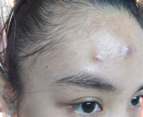 Blind Pimple A Blind Zit Refers To Acne That S Grown Under Your Skin Surface Even Though