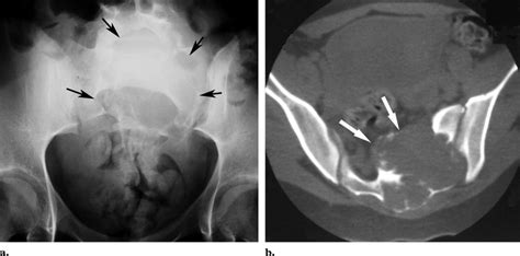 Aneurysmal Bone Cyst In A 15 Year Old Boy With Back Pain Lower