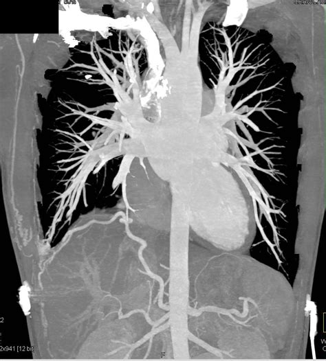 Arteriovenous Malformation Avm Involves The Right Chest Wall Chest
