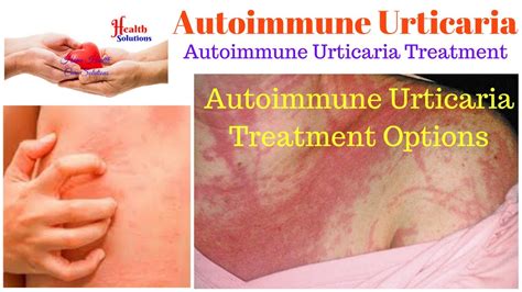 Autoimmune Urticaria Autoimmune Urticaria Treatment Options