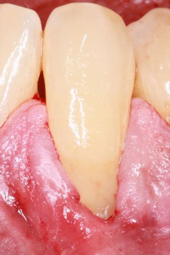 Treatment Of Gingival Recession When And How Imber