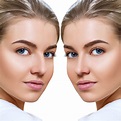 Non Surgical Nose Job Before and After - BellevueRX