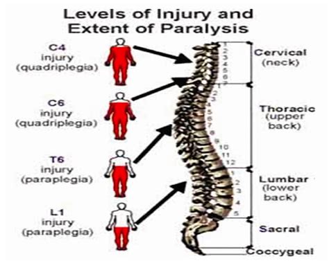 What Are The Different Types Of Spinal Cord Injuries