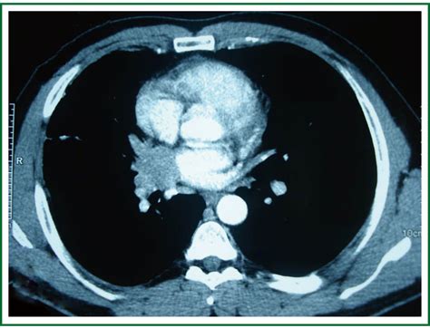 Fibrosing Mediastinitis Mimicking Bronchogenic Carcinoma Koksal
