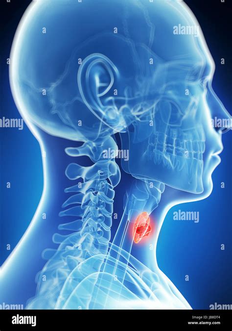 Neck Abscess High Resolution Stock Photography And Images Alamy
