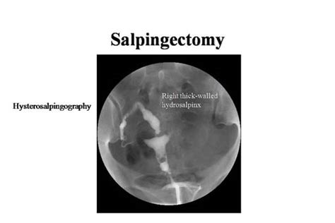 Salpingectomy Part 2 Slides Glowm