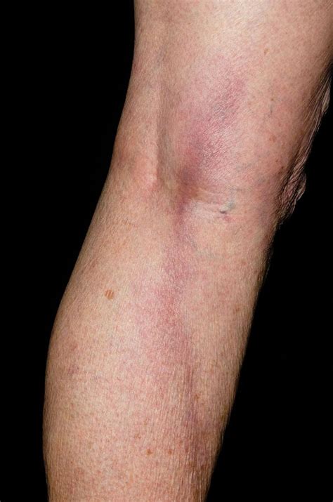 Thrombophlebitis In The Leg Photograph By Dr P Marazziscience Photo