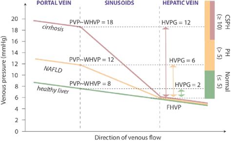 Portal And Hepatic Venous Pressure In Sinusoidal Portal Hypertension