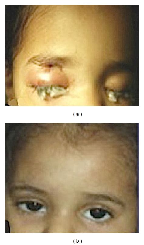 Photographs Of The Patient Showing Right Periorbital Swelling Before