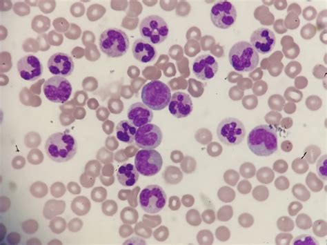 Eighty Year Old Man With Rare Chronic Neutrophilic Leukemia Caused By