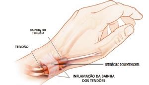 Tendinite da base do polegar Clínica da Mão