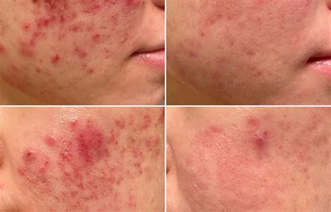 Different Types Of Atrophic Acne Scars And How To Treat Them