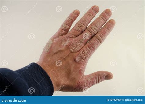 Exacerbation Of Psoriasis In The Hands Stock Photo Image Of Hand