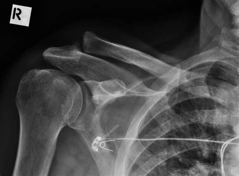 Shoulder X Ray Right Acromioclavicular Joint Dislocation Radrounds