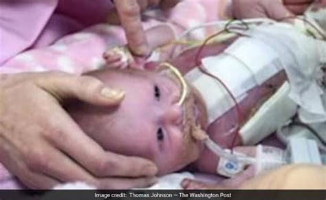 Baby Was Born With Her Heart Outside Body And Survived जन्म लेने के