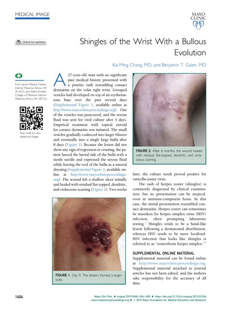 Pdf Shingles Of The Wrist With A Bullous Evolution