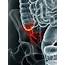 Inflamed Appendix Artwork  Stock Image F009/3792 Science Photo