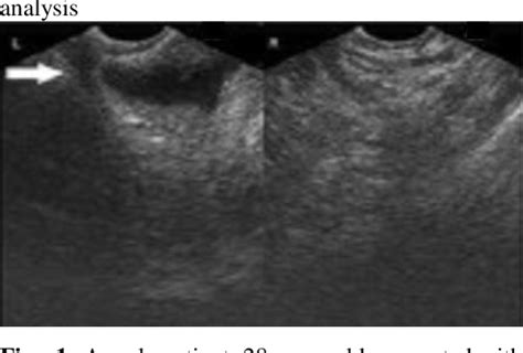Figure 1 From Role Of Trans Rectal Ultrasonography For Evaluation Of