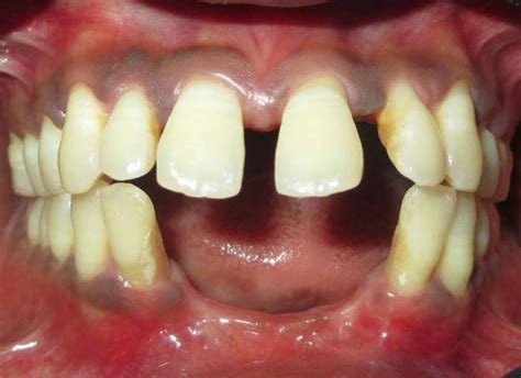 Postoperative After Periodontal Therapy For Treatment Of Aggressive