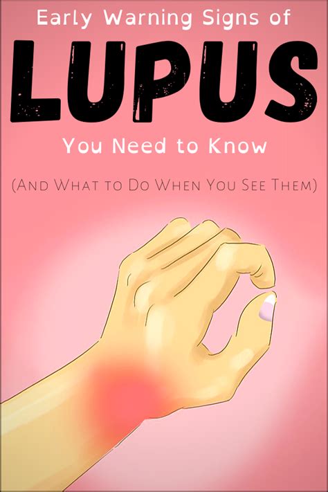 Early Warning Signs Of Lupus You Need To Know And What To Do When You