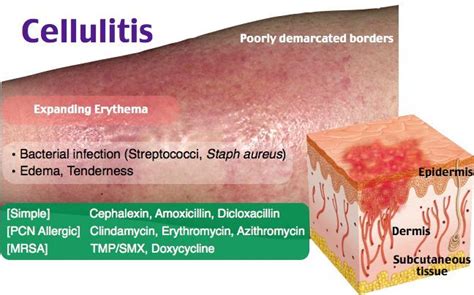 Cellulitis Dm Is Rfcellulitis Dm Is Rf Dermatology Dermatology