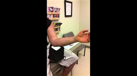Compound Fracture After Surgery With Dislocated Wrist YouTube