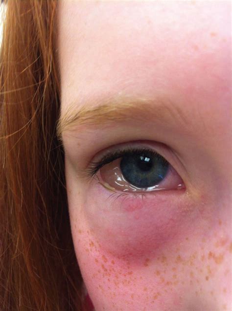 Swollen Sclera Eye