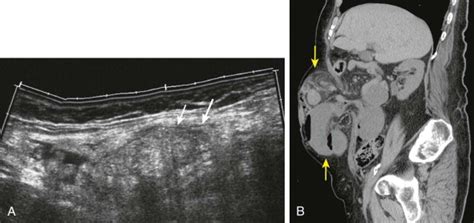 Hernias And Abdominal Wall Pathology Radiology Key