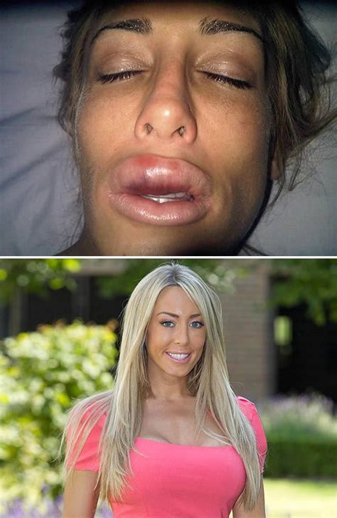 Plastic Surgery Fails 8 Lip Enhancements Gone Wrong Oddee Plastic