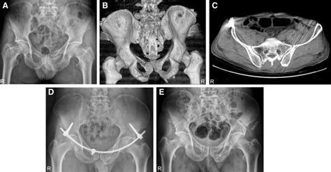 A 38 Year Old Male Patient With Anterior Pelvic Ring Fracture Caused By