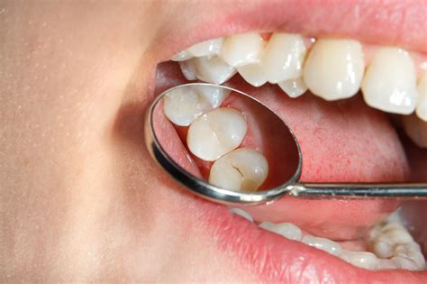 Décalcification Des Dents Causes Et Traitements Possibles