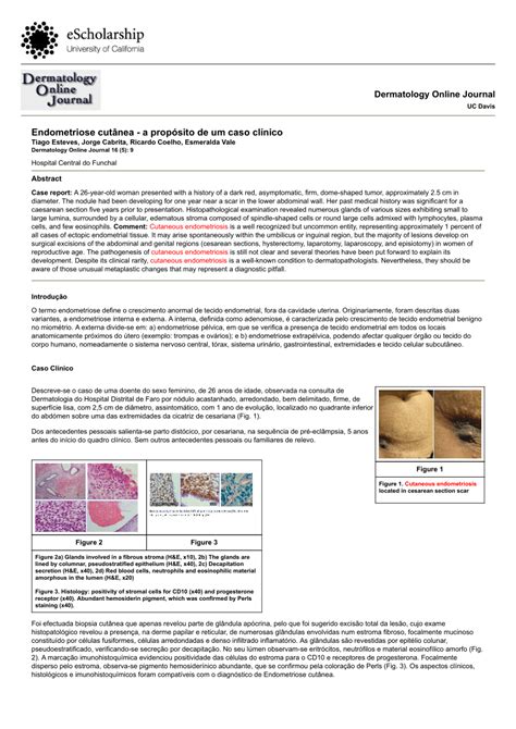 Pdf Cutaneous Endometriosis Clinical Case Report