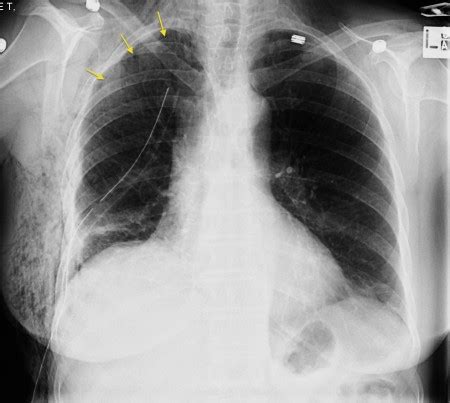 Pneumothorax And Surgical Emphysema Radiology At St Vincent S University Hospital
