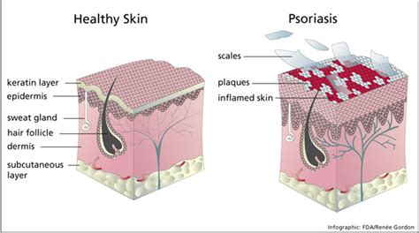 Psoriasis Causes And Treatments Victorian Cosmetic Dermal Clinics