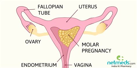 Molar Pregnancy Causes Symptoms And Treatment