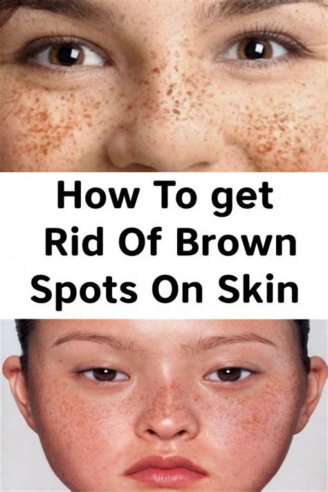 Tips On How To Get Rid Of Brown Spots On Face Yourcreativedesign