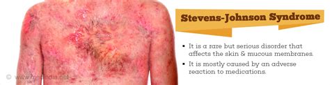 And the answer is a simple no. Stevens-Johnson Syndrome - Causes, Symptoms, Diagnosis ...