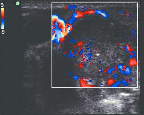 Inflamed Lymph Node Ultrasound