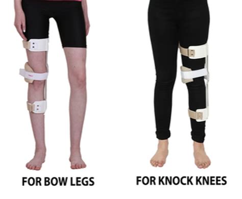 Salo Orthotics Knee Genu Valgum Genu Varum Splint Knock Knee And Bow Leg